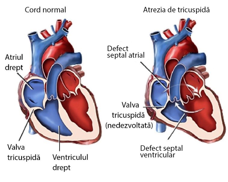 Figura 28 – Atrezia de tricuspidă