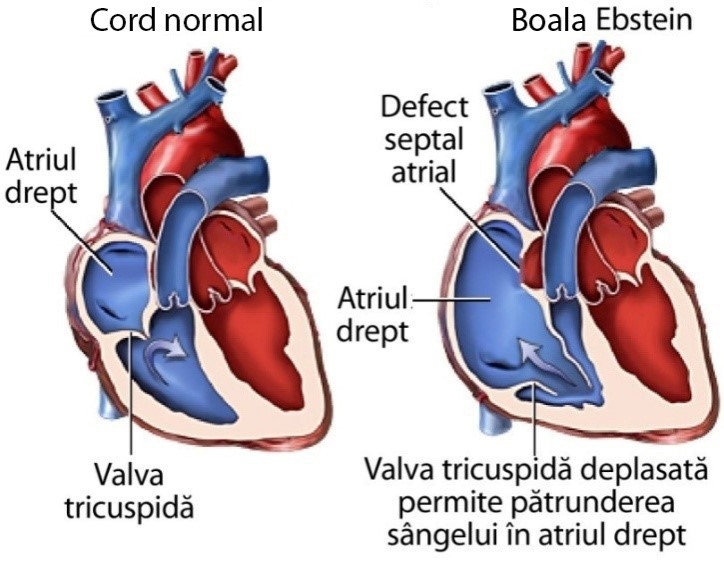 Schemă a implantării anormale a valvei tricuspide în boala Ebstein