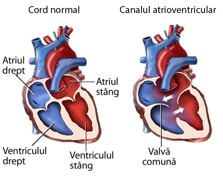 Canal atrioventricular – schemă