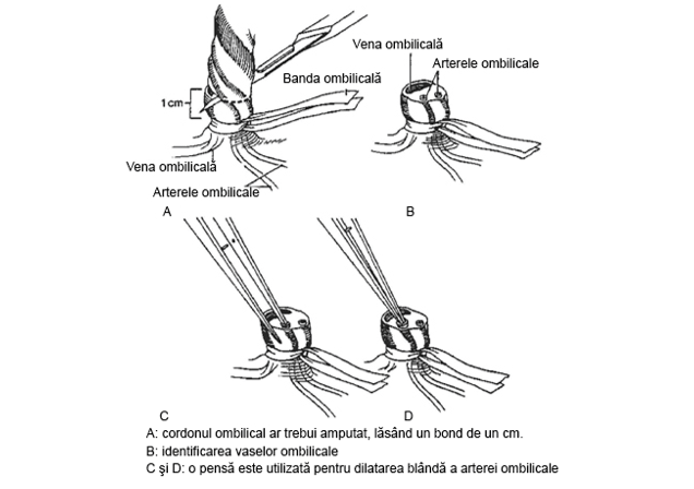 Cateterizarea vaselor ombilicale - schema