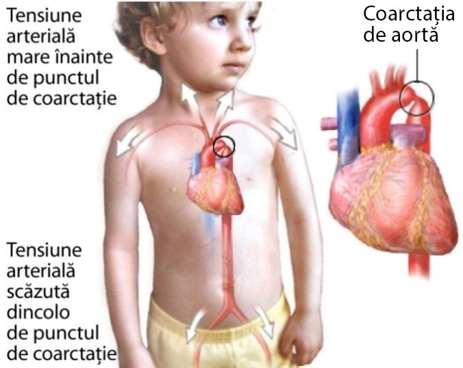 Coarctația de aortă – schemă