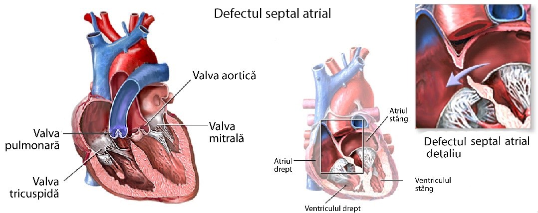 Defectul septal atrial – detaliu