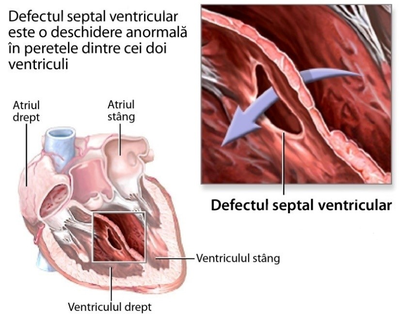 Defectul septal ventricular – schemă