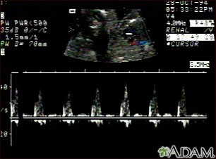 Tip de malformație cardiacă