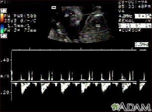 Tip de malformație cardiacă