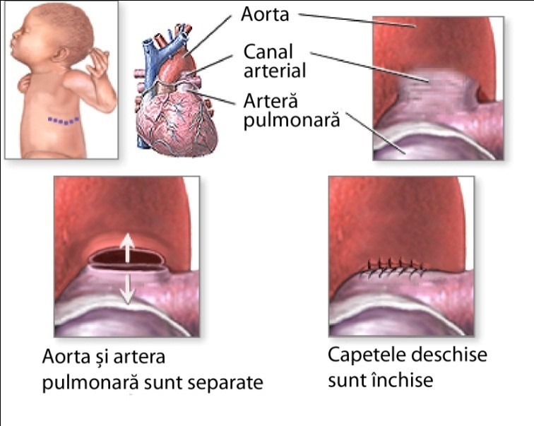 Persistența de canal arterial – detaliu