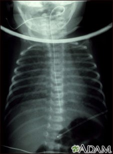 Retur venos total aberant - implantarea venelor pulmonare