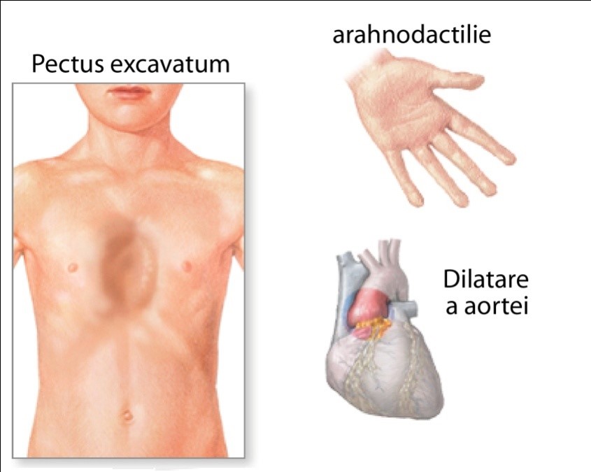 Pectus excavatum, imagine frontală
