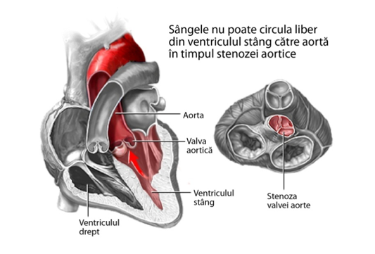 Stenoză aortică – schemă