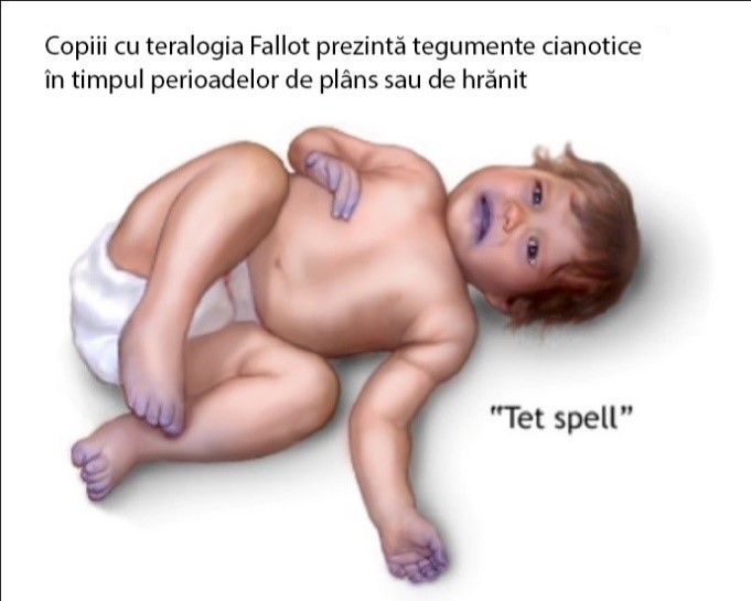 Schema anomaliilor cardiace din tetralogia Fallot