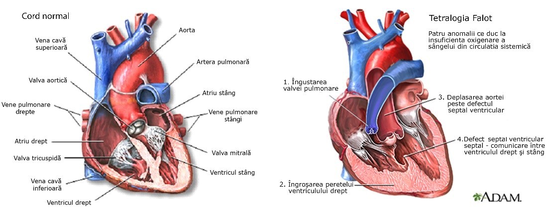 Ilustrație a malformației cardiace tetralogia Fallot