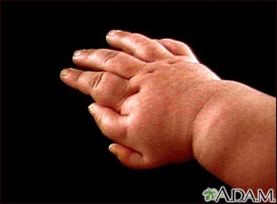 Polidactilie