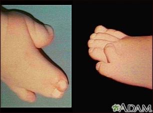 Sindactilie